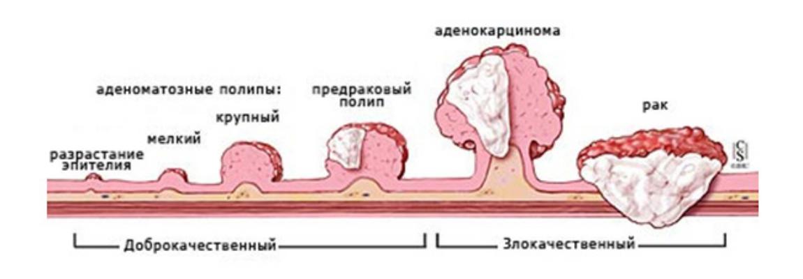 Полипы в кишечнике. Удалять полипы или нет? Что делать после удаления? Полная инструкция